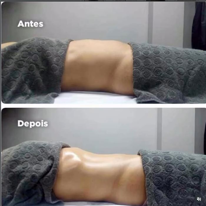 Resultado real de sessão de drenagem linfática, antes e depois